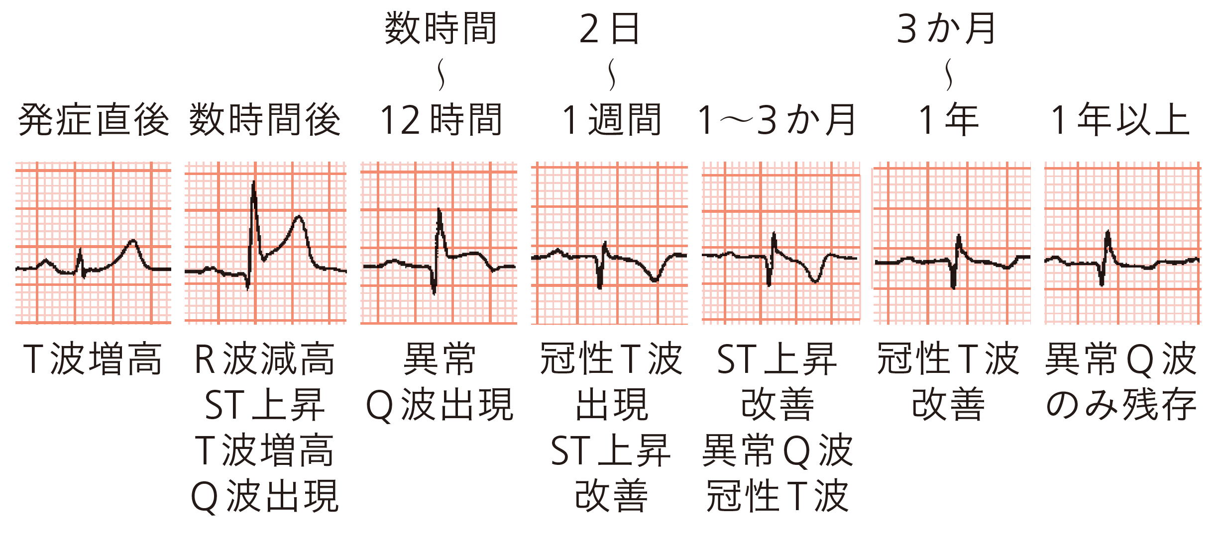 図C　急性心筋梗塞症例における心電図の経時的変化