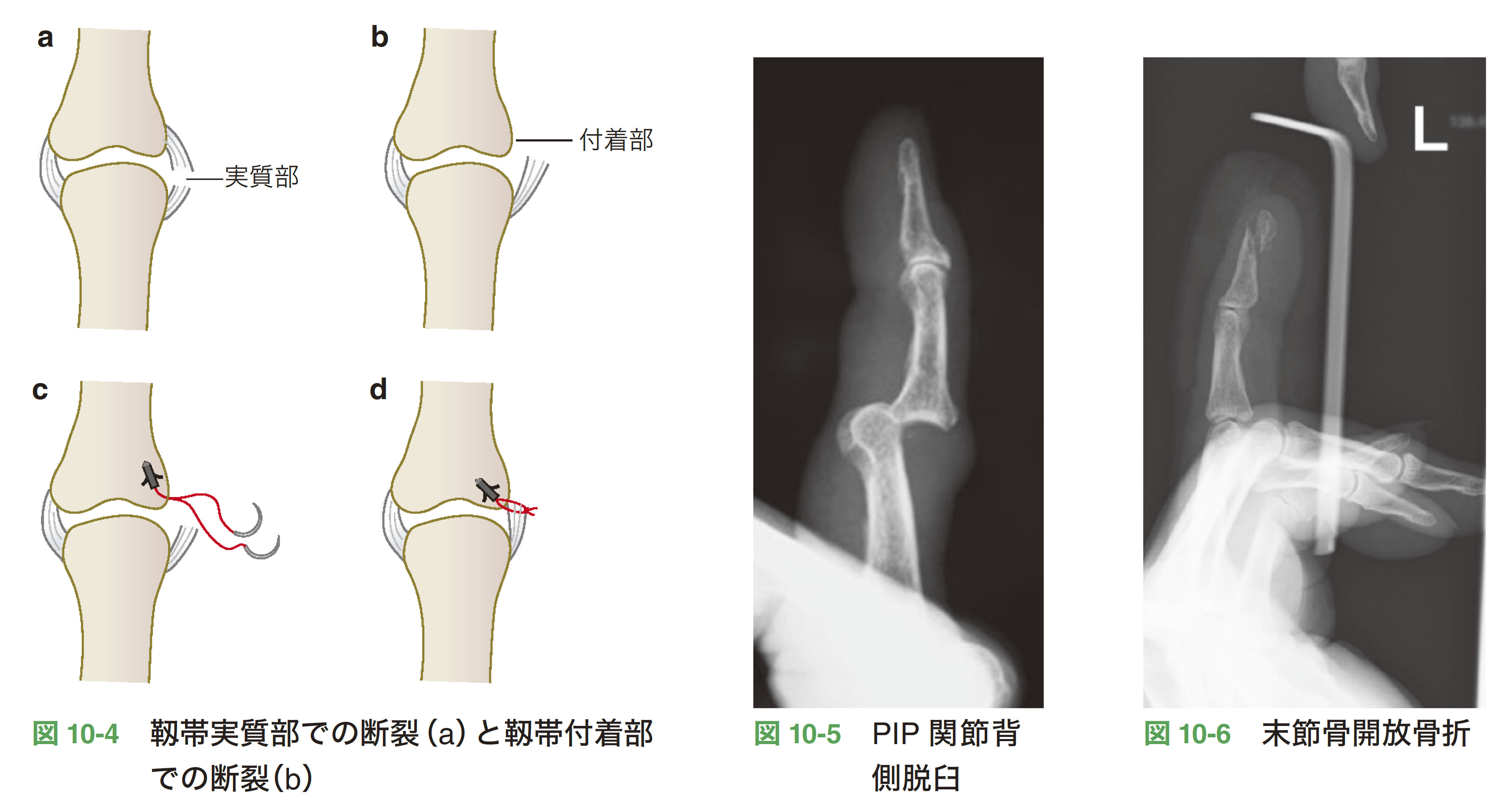 骨折　脱臼の管理　骨折治療法