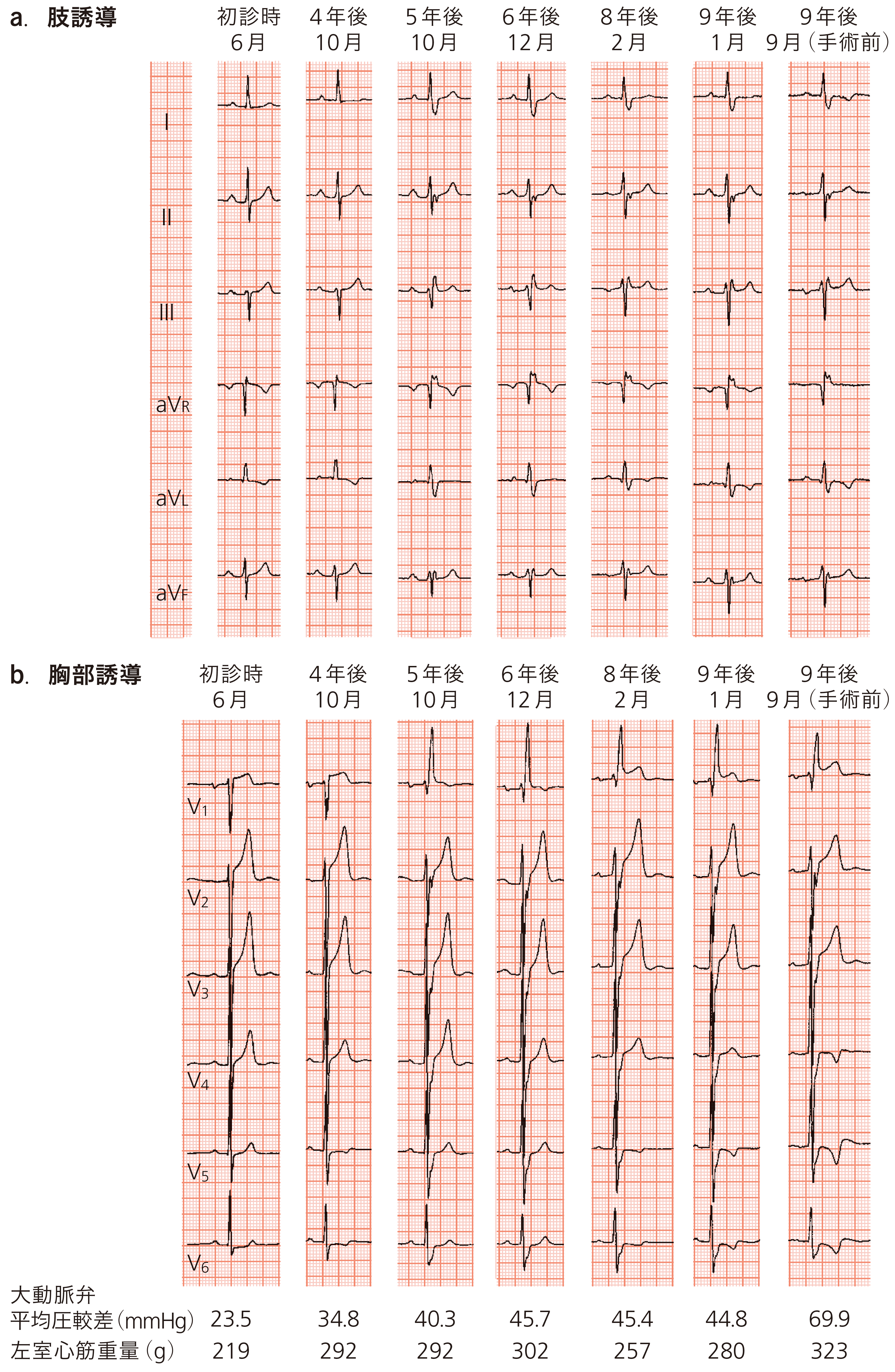 図A　12誘導心電図の推移