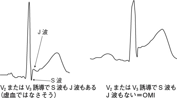 はぐれSTEMI”を探せ！ 絶対に見逃してはならない心電図波形12選