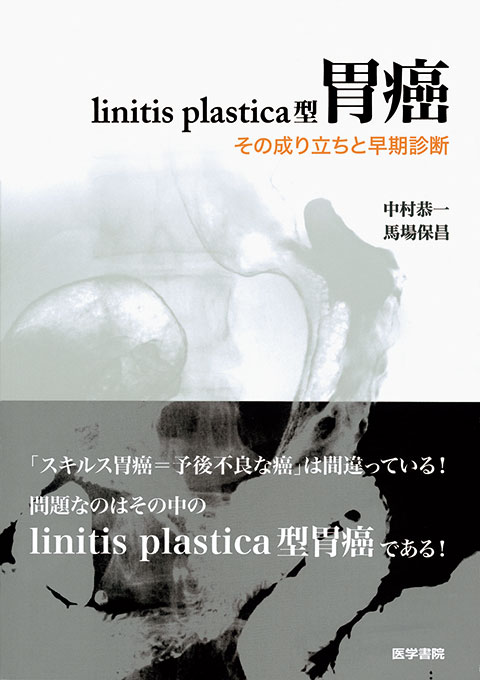 linitis plastica型胃癌