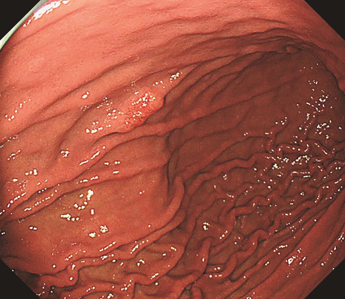 医学界新聞プラス ［第1回］H. pylori未感染胃癌――診断に苦慮した症例
