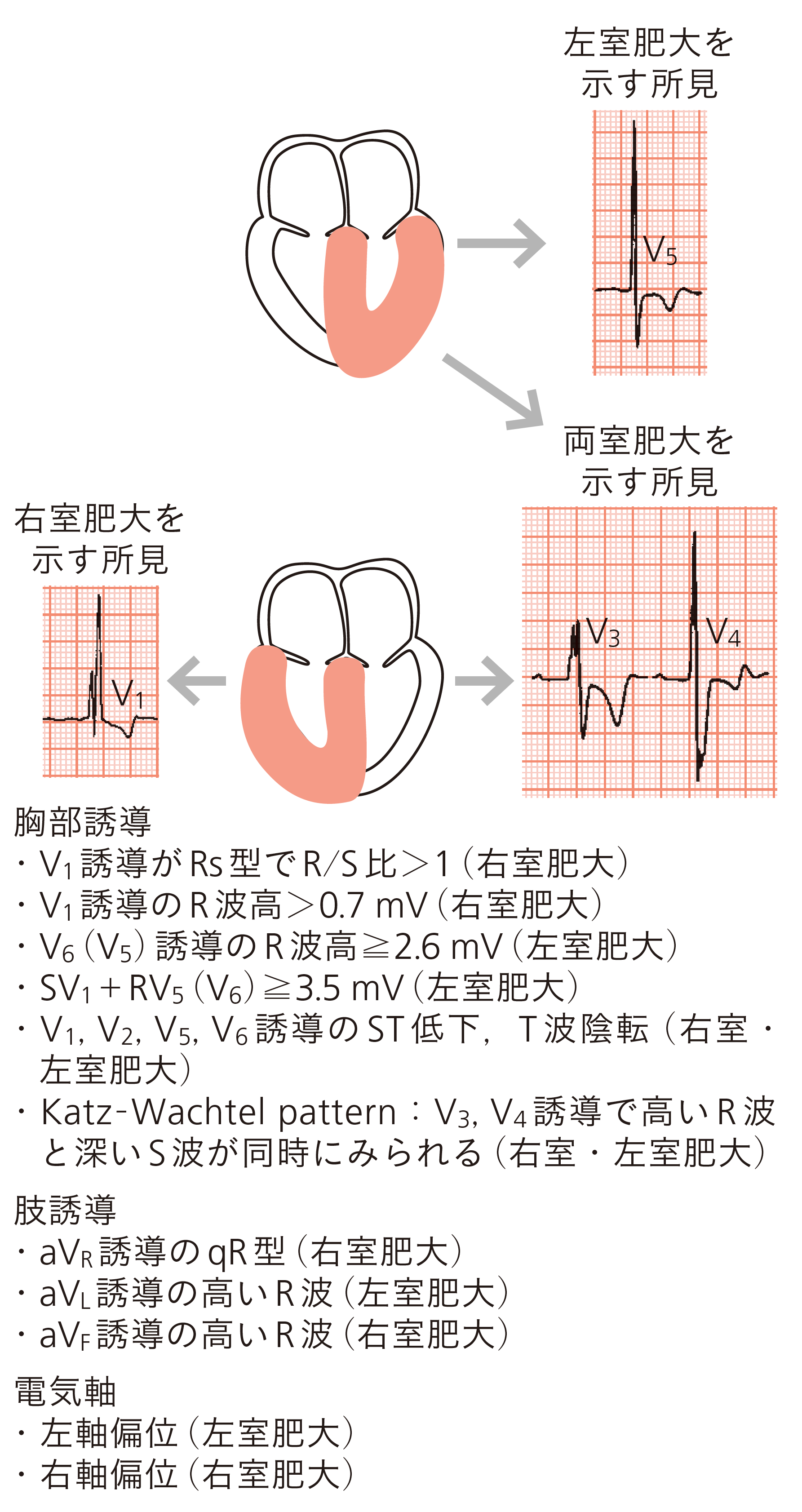 図A　両室肥大の診断に参考となる所見