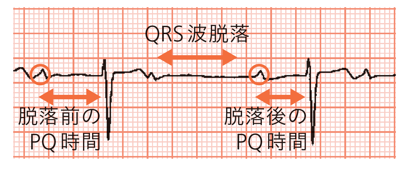 ［症例1］V1誘導