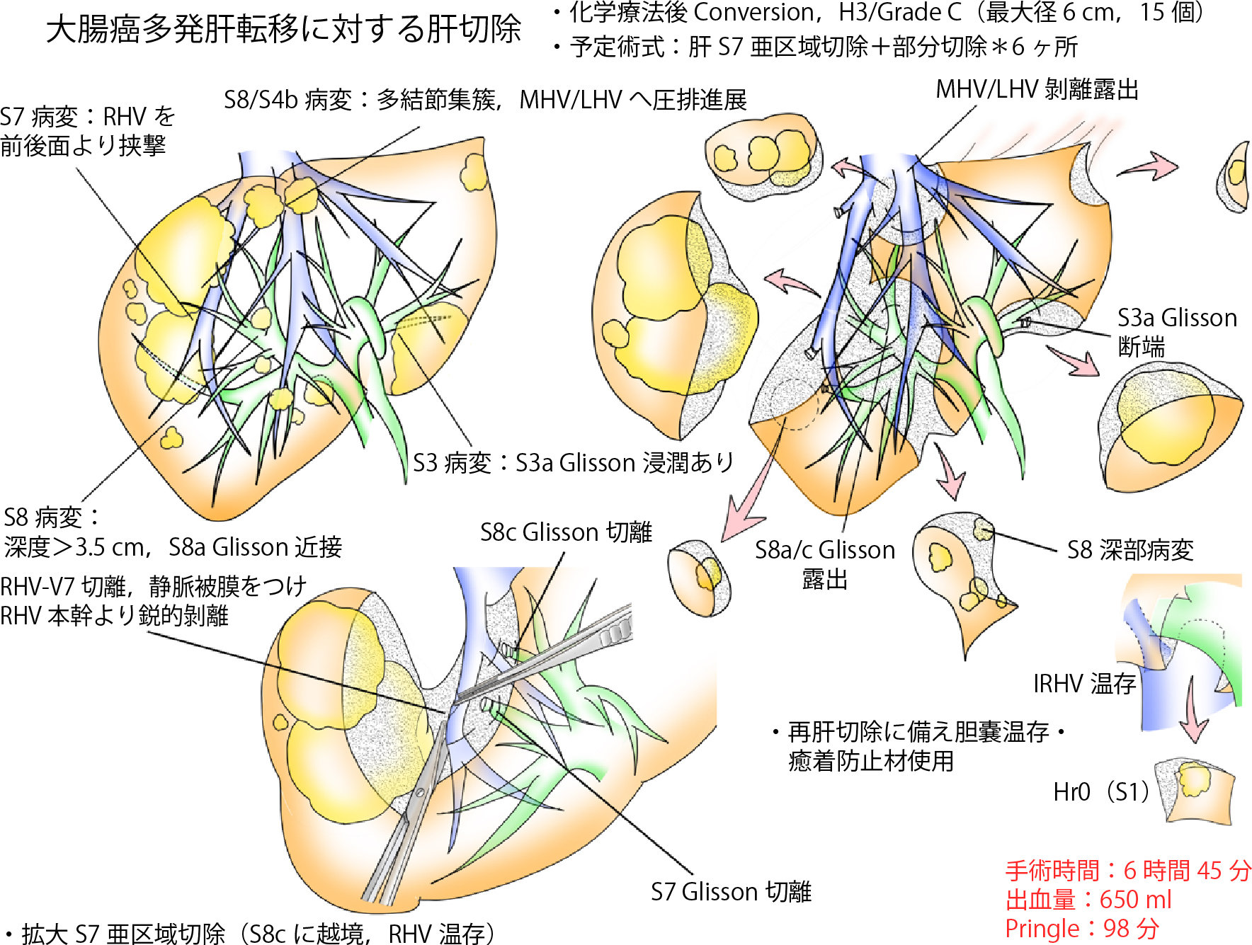 デジタルイラストで効率的に効果的なオペレコを描いてみよう 21年 記事一覧 医学界新聞 医学書院 デジタルイラストで効率的に効果的なオペレコを描いてみよう 21年 記事一覧 医学界新聞 医学書院
