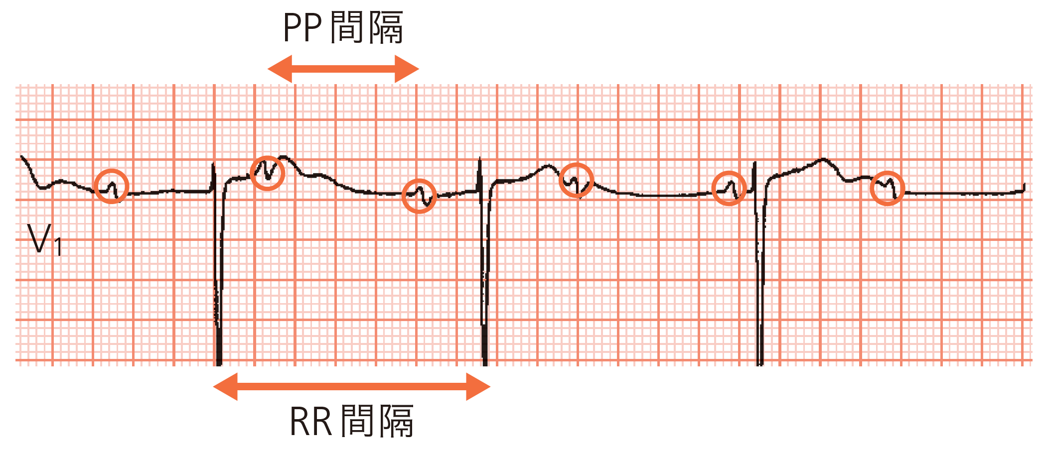 ［症例2］V1誘導