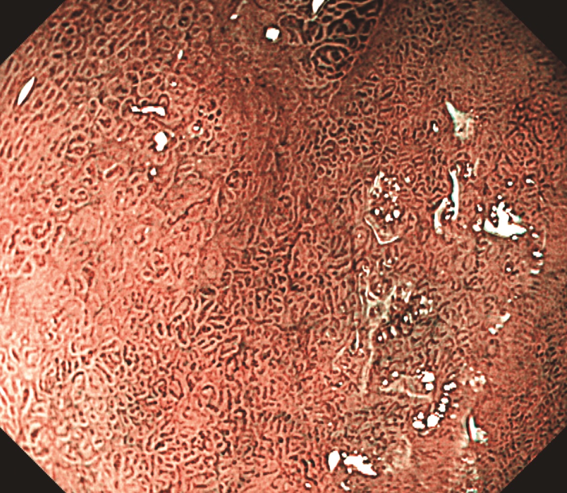 医学界新聞プラス ［第2回］H. pylori 除菌後胃癌――非腫瘍上皮の被覆，混在（70歳代，女性） | 2021年 | 記事一覧 | 医学界新聞  | 医学書院
