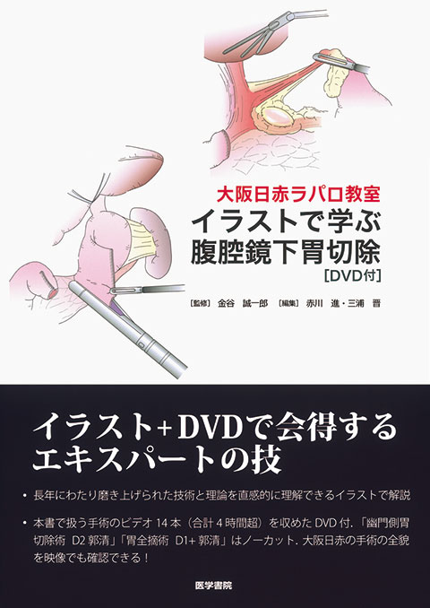 イラストで学ぶ腹腔鏡下胃切除［DVD付］