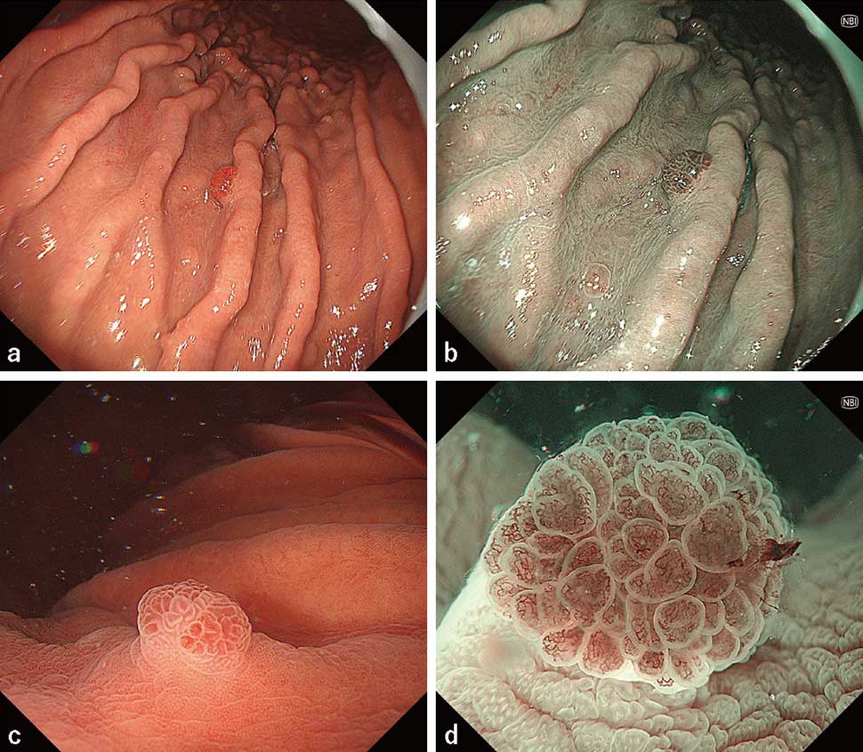 図1　胃の腺窩上皮型腺癌（ラズベリー型胃癌）
