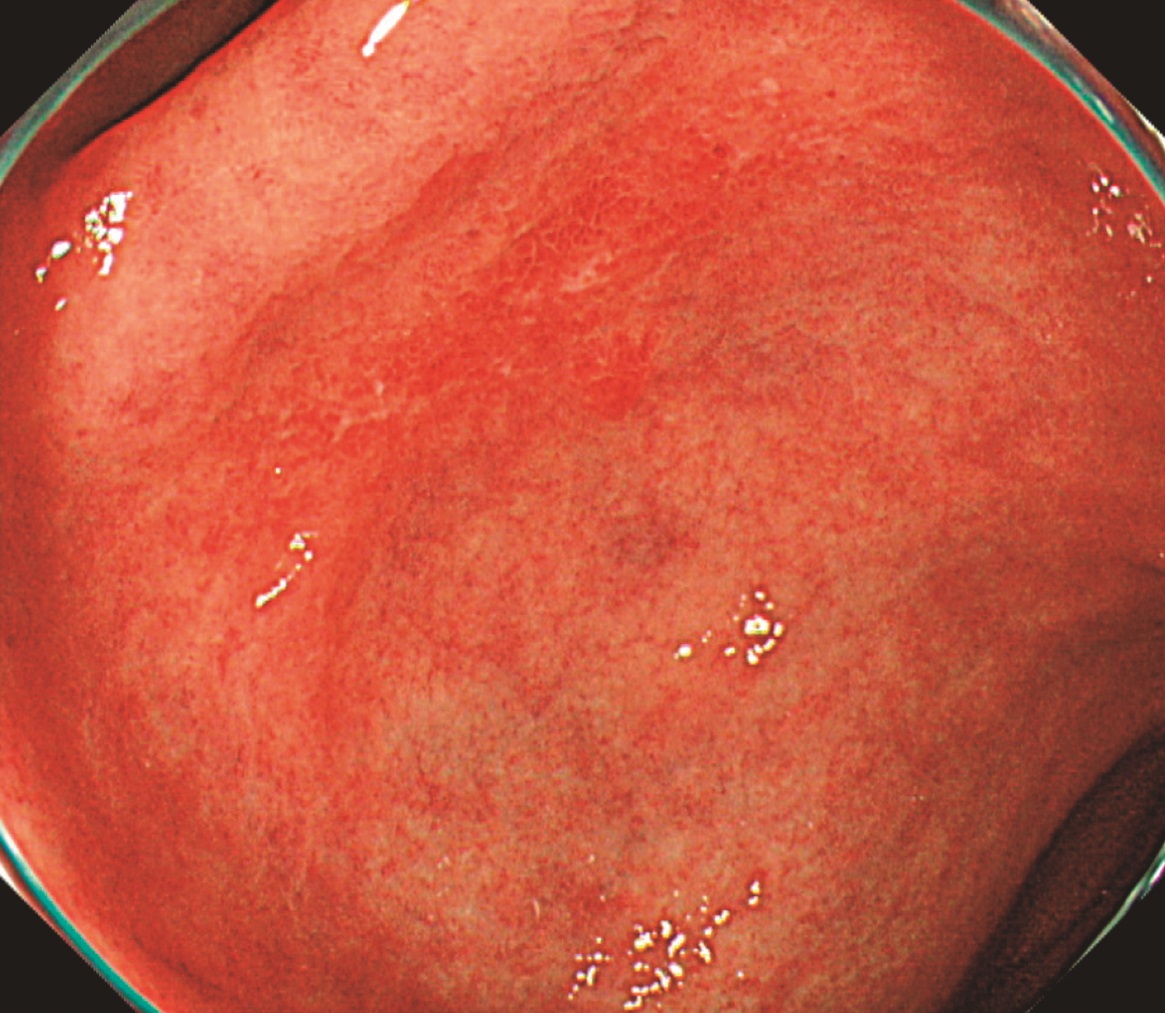 医学界新聞プラス ［第2回］H. pylori 除菌後胃癌――非腫瘍上皮の被覆 