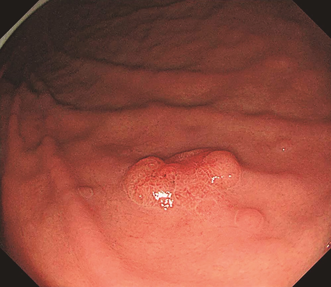 医学界新聞プラス ［第1回］H. pylori未感染胃癌――診断に苦慮した症例