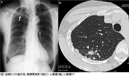 今月の主題 症例からみる肺疾患のct画像 Medicina44 2