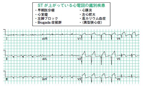 心電図のレッドゾーン St上昇 その1 香坂俊 2011年 記事一覧 医学界新聞 医学書院