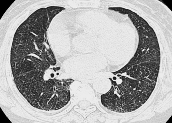 肺領域 隈丸加奈子 村山貞之 17年 記事一覧 医学界新聞 医学書院