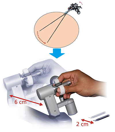 Da Vinci手術の利点と課題 絹笠祐介 2018年 記事一覧 医学界新聞 医学書院