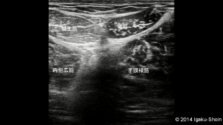 「縫工筋 薄筋 エコー」の画像検索結果