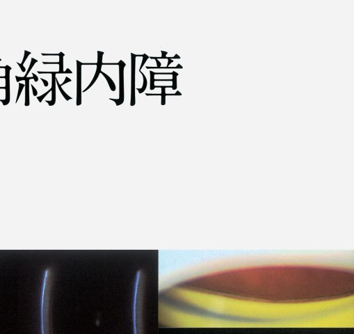 All About 原発閉鎖腺角膜内障 Amazon.co.jp: All About 原発閉塞隅角緑内障 (眼科臨床