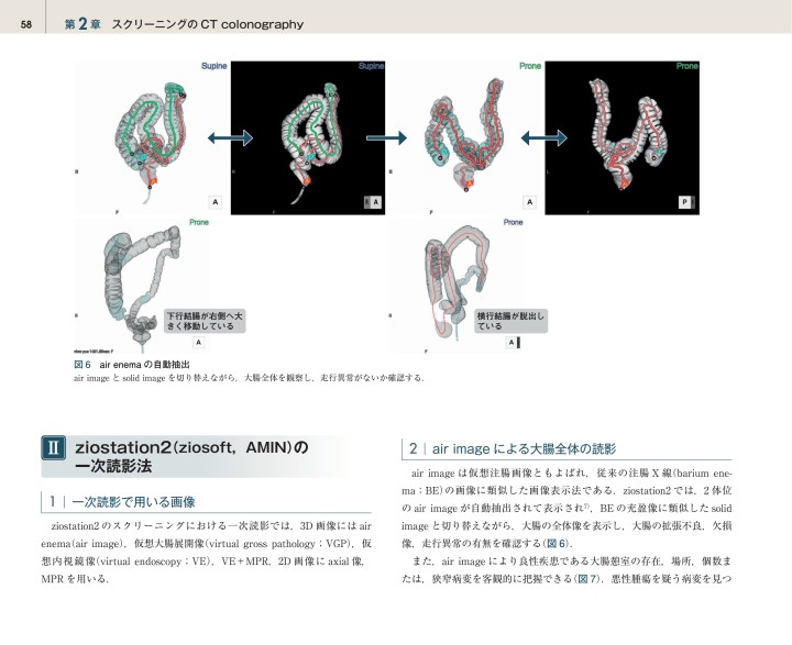 CT Colonography 実践ガイドブック CT Colonography 実践ガイドブック | 野崎 良一 |本 | 通販 | Amazon