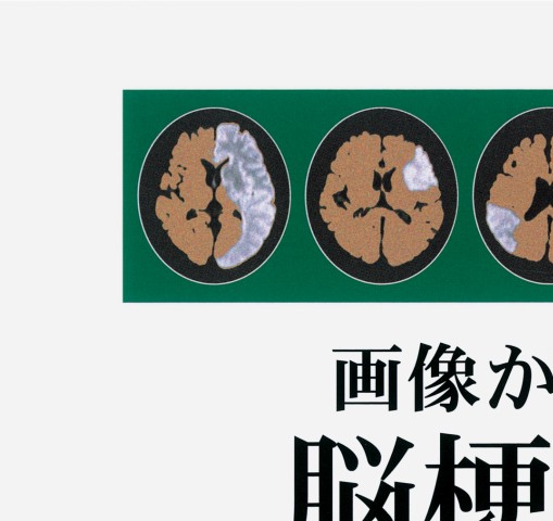 画像からみた脳梗塞と神経心理学』 立ち読み