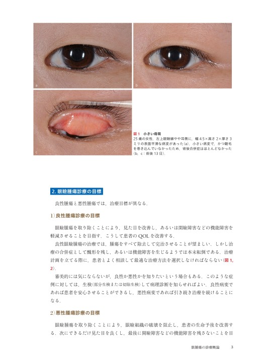 眼科臨床EX》知っておきたい眼腫瘍診療