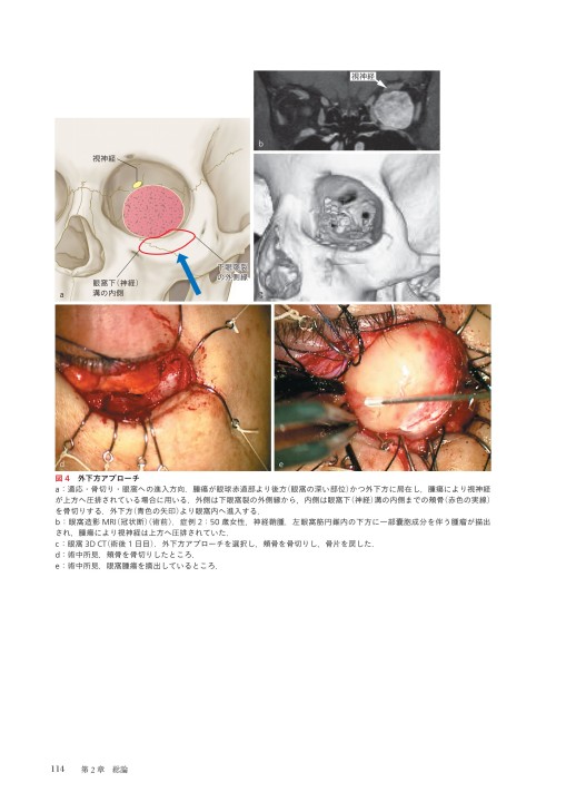眼科臨床EX》知っておきたい眼腫瘍診療