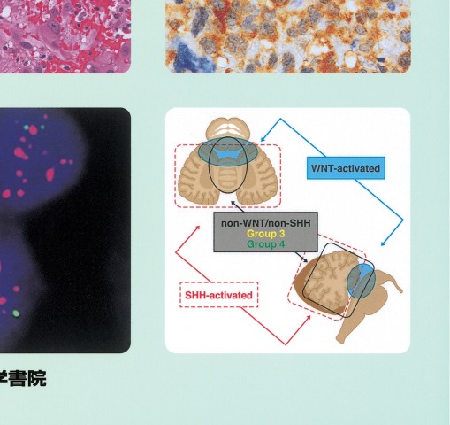 脳腫瘍臨床病理カラーアトラス 第4版』 立ち読み