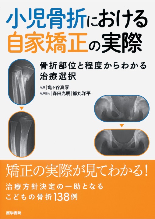 小児骨折における自家矯正の実際 立ち読み