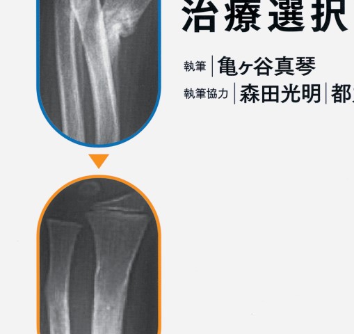 小児骨折における自家矯正の実際 立ち読み