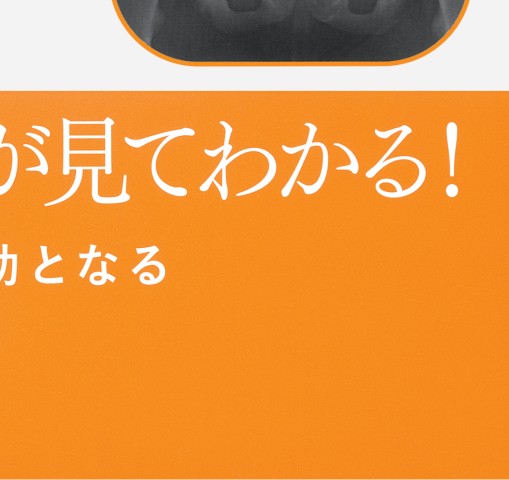 小児骨折における自家矯正の実際 立ち読み