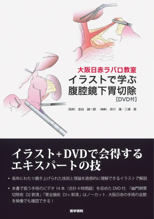 大阪日赤ラパロ教室］イラストで学ぶ腹腔鏡下胃切除［DVD付