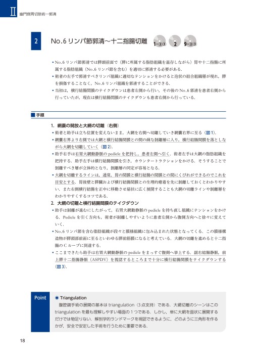 大阪日赤ラパロ教室］イラストで学ぶ腹腔鏡下胃切除［DVD付