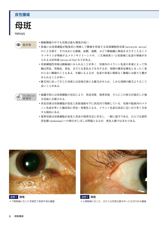 眼内腫瘍アトラス 裁断済み 眼内腫瘍アトラス 裁断済み Amazon.co.jp: 眼内腫瘍アトラス