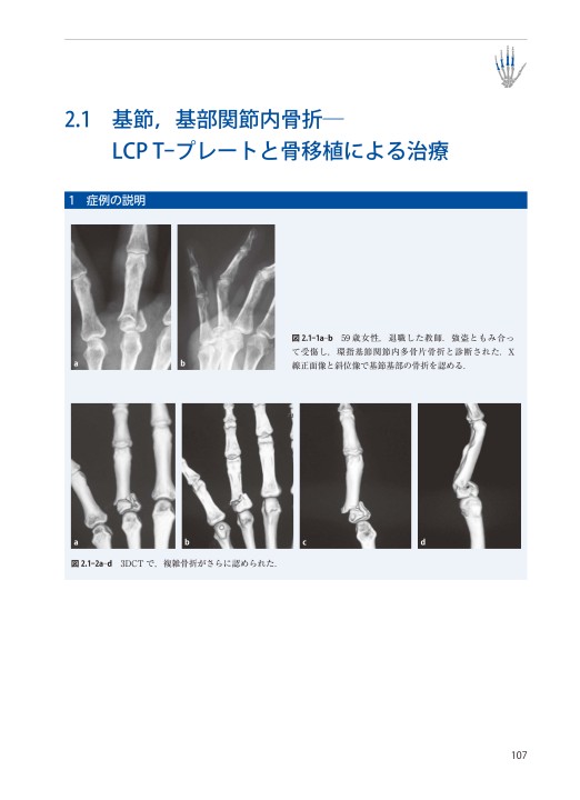 AO法 骨折治療 Hand』 立ち読み