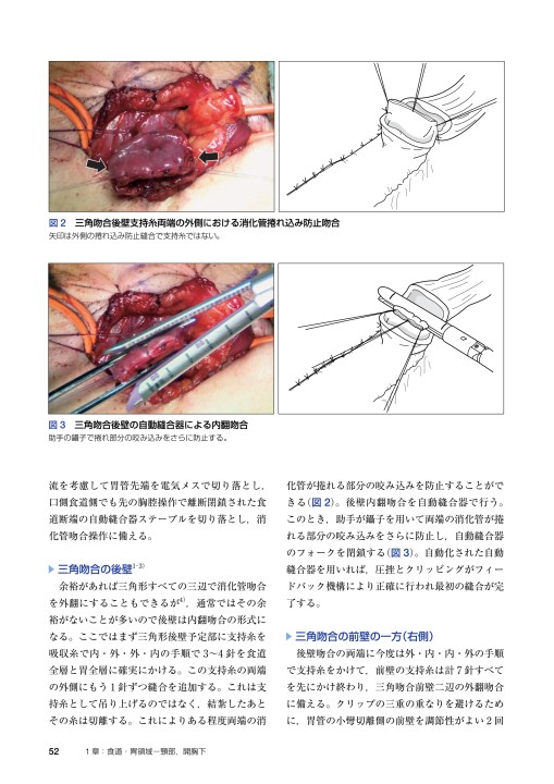 消化管吻合法バイブル［Web動画付］理学』 立ち読み