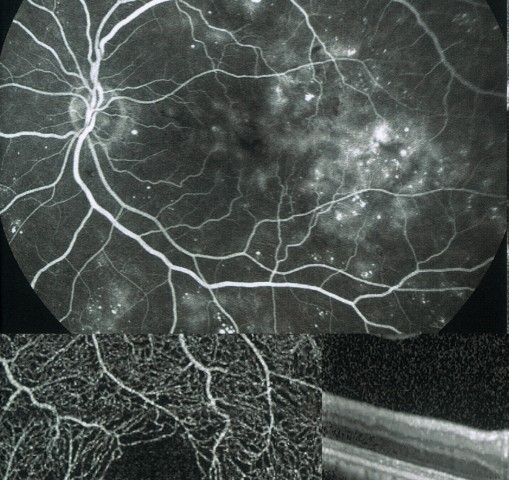 蛍光眼底造影ケーススタディ エキスパートはFA・IA・OCTAをこう  