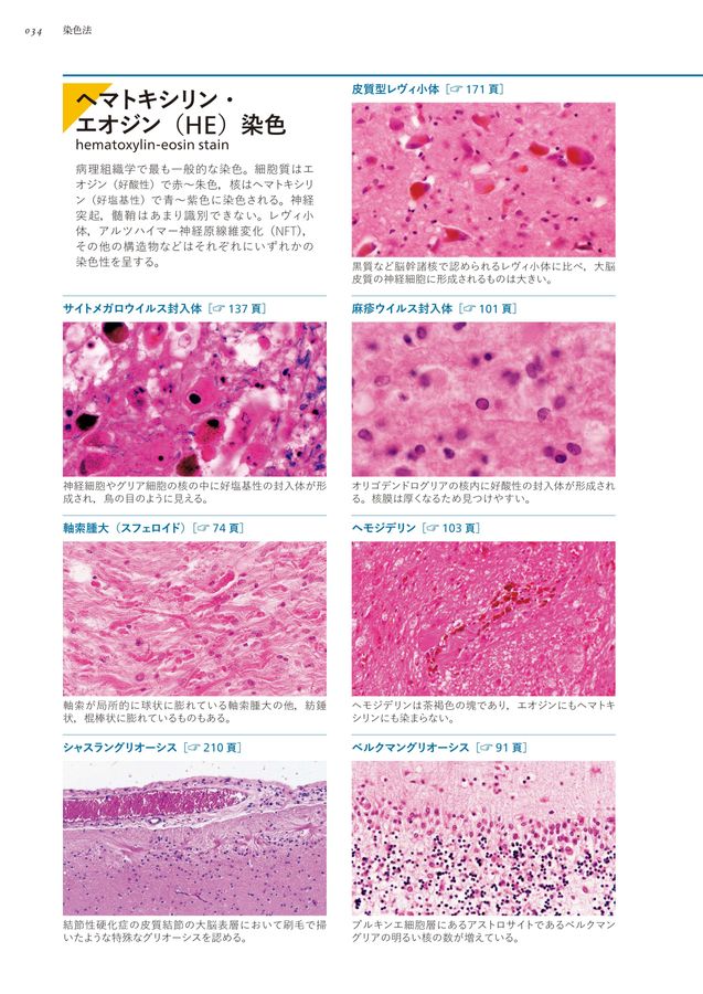 未病神経病理 ALSの早期病態において重要なTDP-43病理のメカニズムの一端が